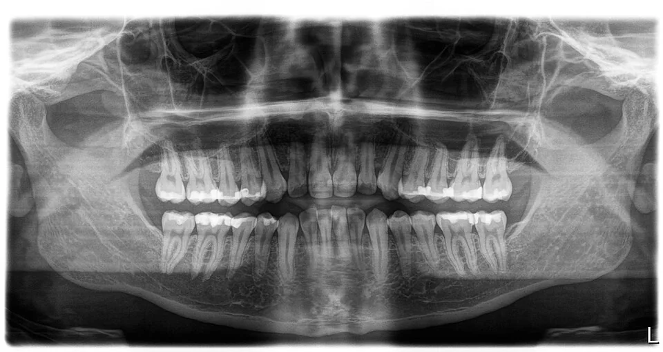 Radiografía panorámica dental de ambos maxilares