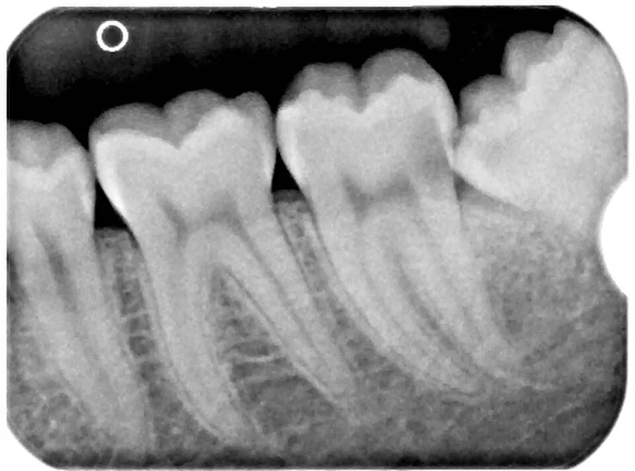 Radiografía retroalveolar de molares inferiores