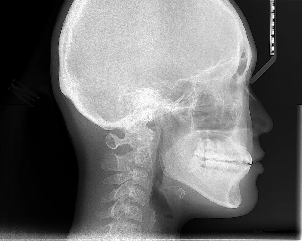 Telerradiografía lateral de cráneo